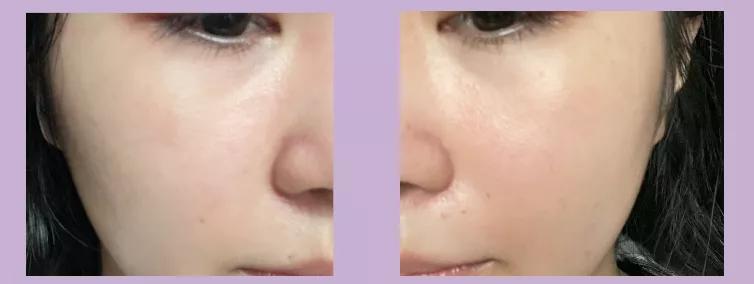 抗炎祛红痘痘,抗炎杀菌药膏痘痘