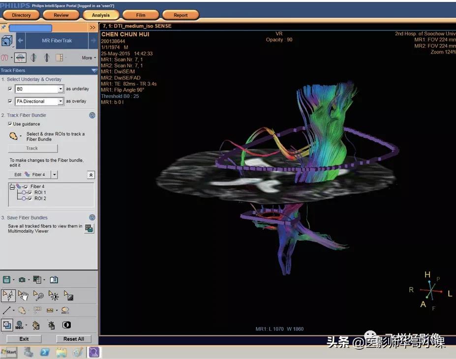飞利浦磁共振波谱成像扫描技术,飞利浦磁共振纵隔扫描技术