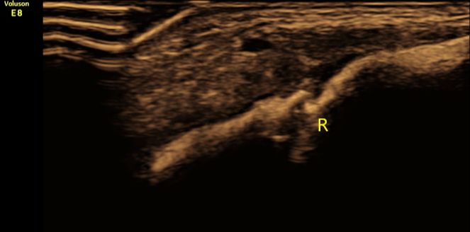 八个月大宝宝锁骨断了,新生儿锁骨断了错位