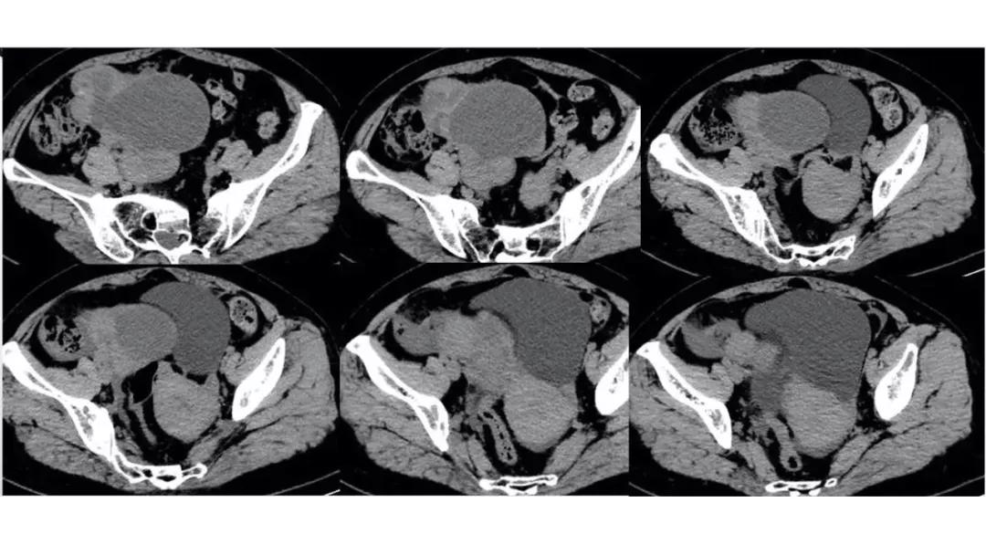 卵巢原发肿瘤的分析思路