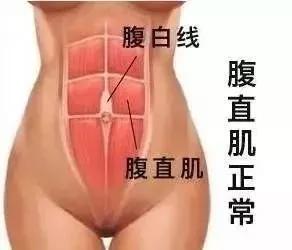 孕妇怎么避免腹直肌分离,孕妇腹直肌分离自测
