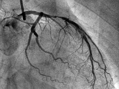 心血管狭窄40%不吃药行吗,心血管狭窄80%不放支架行吗