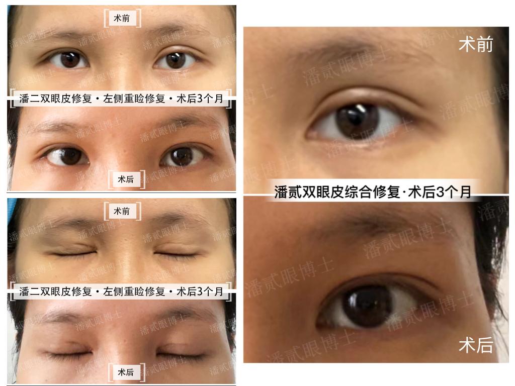 双眼皮修复案例真实,双眼皮修复会越来越糟吗