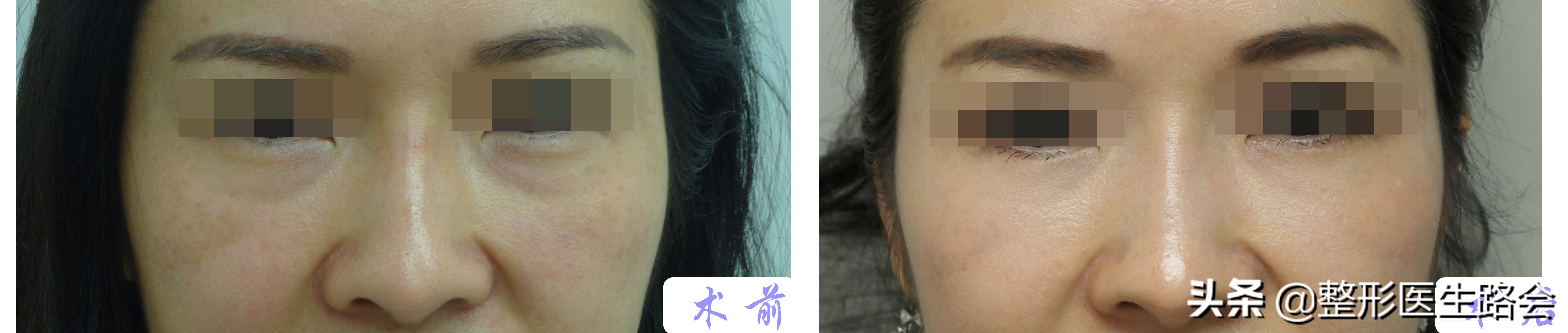 注射泪沟淤青一般需要几天好,胶原蛋白注射泪沟淤青多久能好