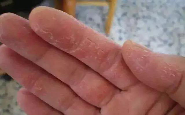 加拿大皲裂霜,加拿大修复膏