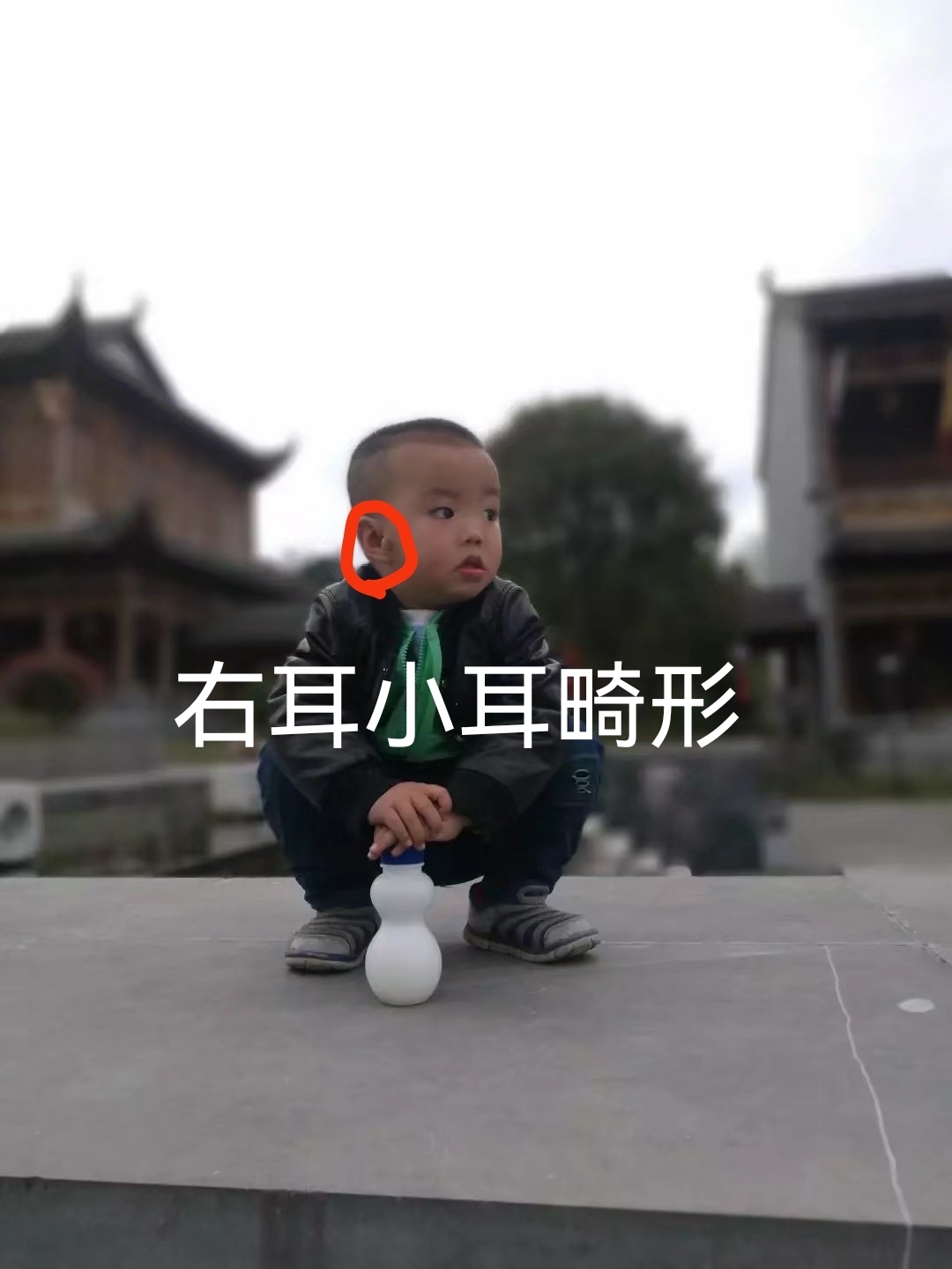 小耳畸形再造手术有后遗症吗,儿童小耳畸形去哪里做手术好