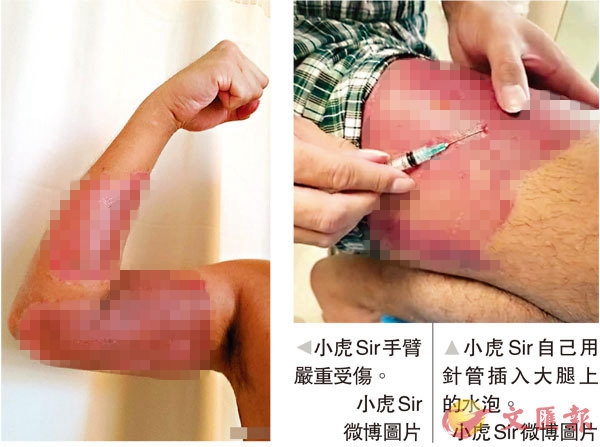 港警每天逐一刺穿伤口上水泡，网友：隔着屏幕都觉得痛