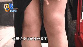 一个变成“猪鼻子”，一个腿歪了？整形医院院长：我也有留疤