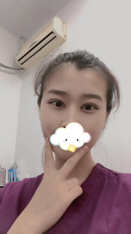 修志夫做双眼皮效果怎么样,修志夫双眼皮修复