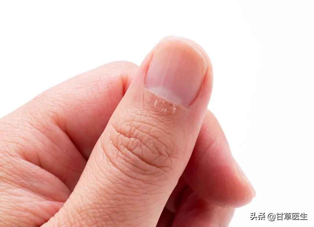 指甲出现这几种变化可能是肿瘤,心血管疾病指甲有变化吗
