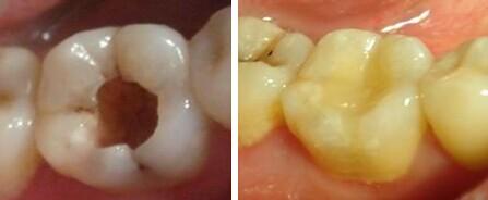 为什么会牙痛?喝冷饮牙痛是怎么回事?