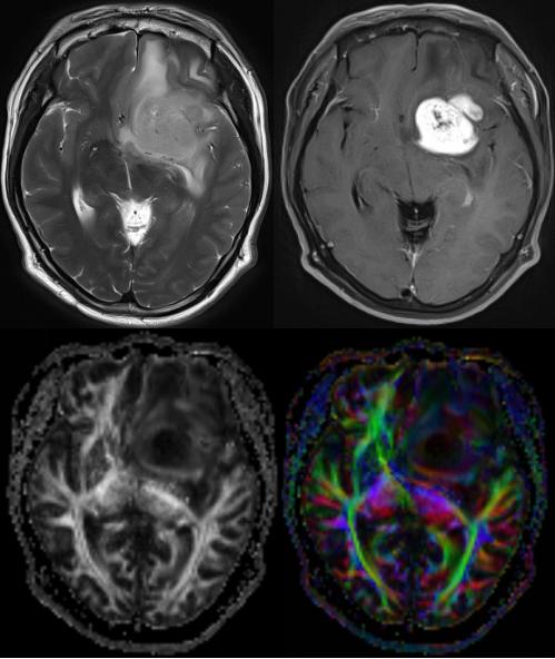 磁共振成像mri的基本原理,磁共振后dti怎么处理