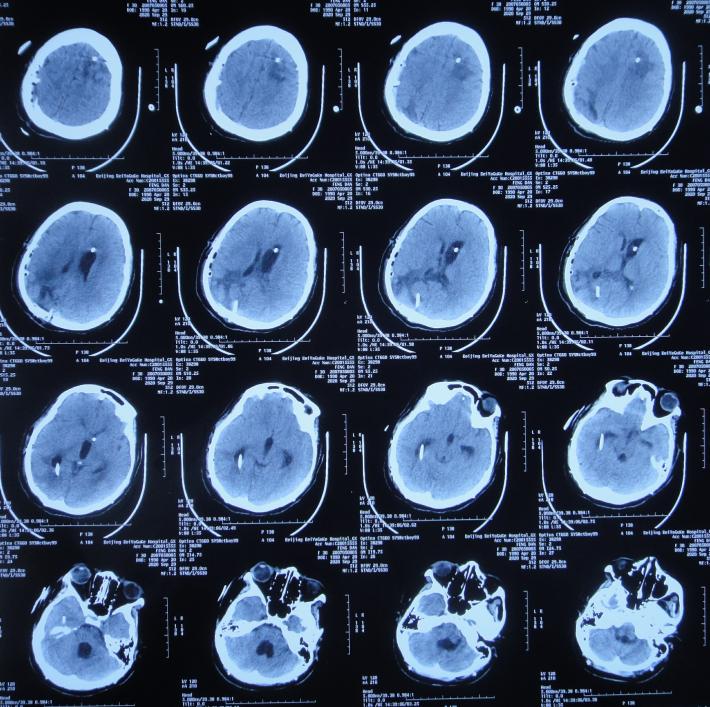 脑室有粘连脑积水有什么办法,脑动脉畸形手术后出现急性脑积水