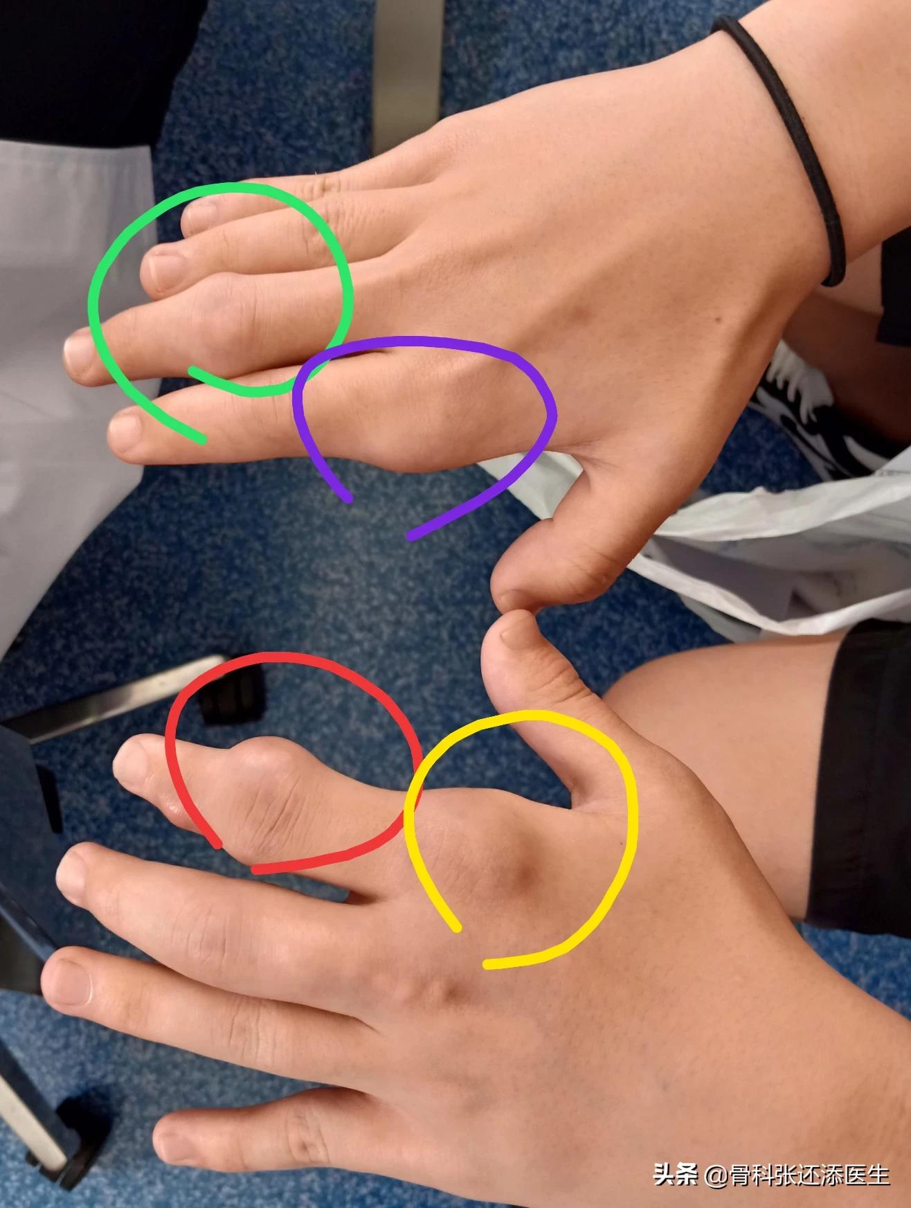 为什么医生不建议痛风石手术,医生为什么不建议痛风石手术