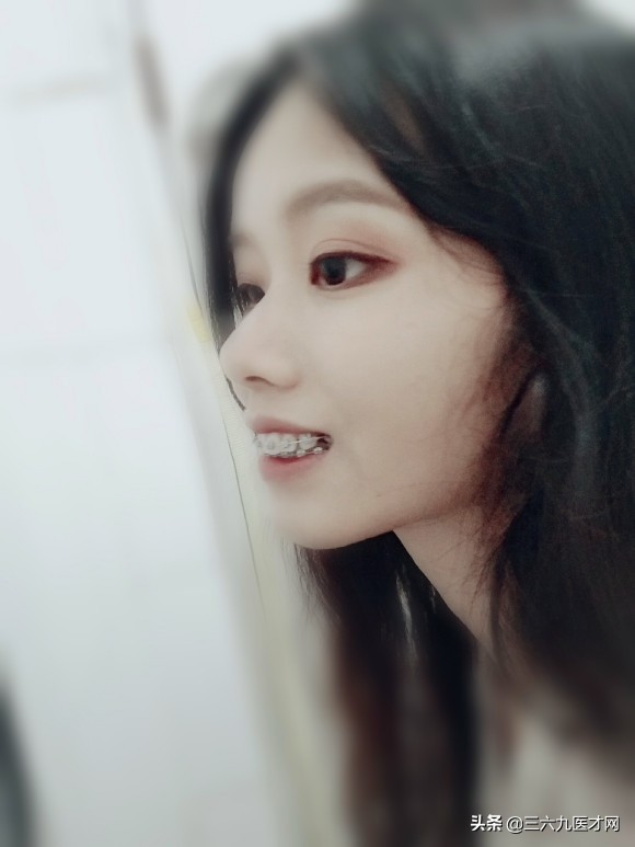 龅牙矫正成功的图片对比,2周岁龅牙可以矫正吗