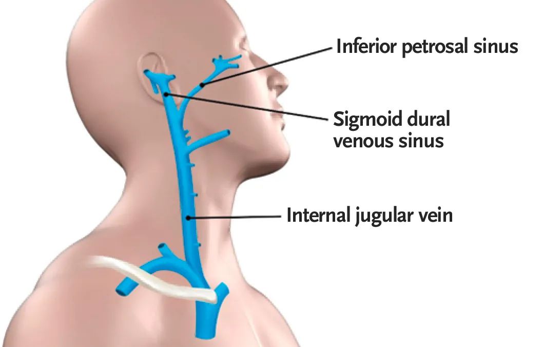 颈内静脉穿刺术禁忌,颈内静脉穿刺术教学视频