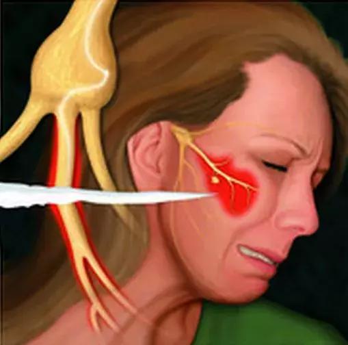 痛得拔光一排牙！解决炸裂“天下第一痛”一根套管针显乾坤