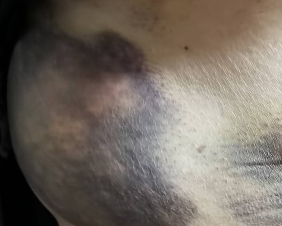 老人皮下出现淤血用药处理,卧床老人皮下出血是怎么回事