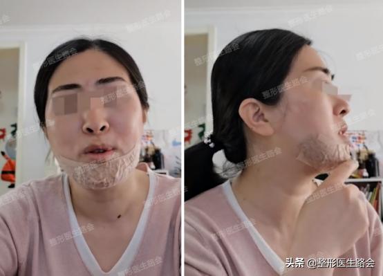 想要垫下巴│材料怎么选？手术疼不疼，过程怎样？听她亲口跟你说