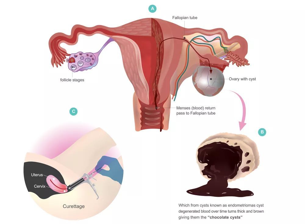 介入栓塞治疗巧克力囊肿,介入超声治巧克力囊肿需要多久