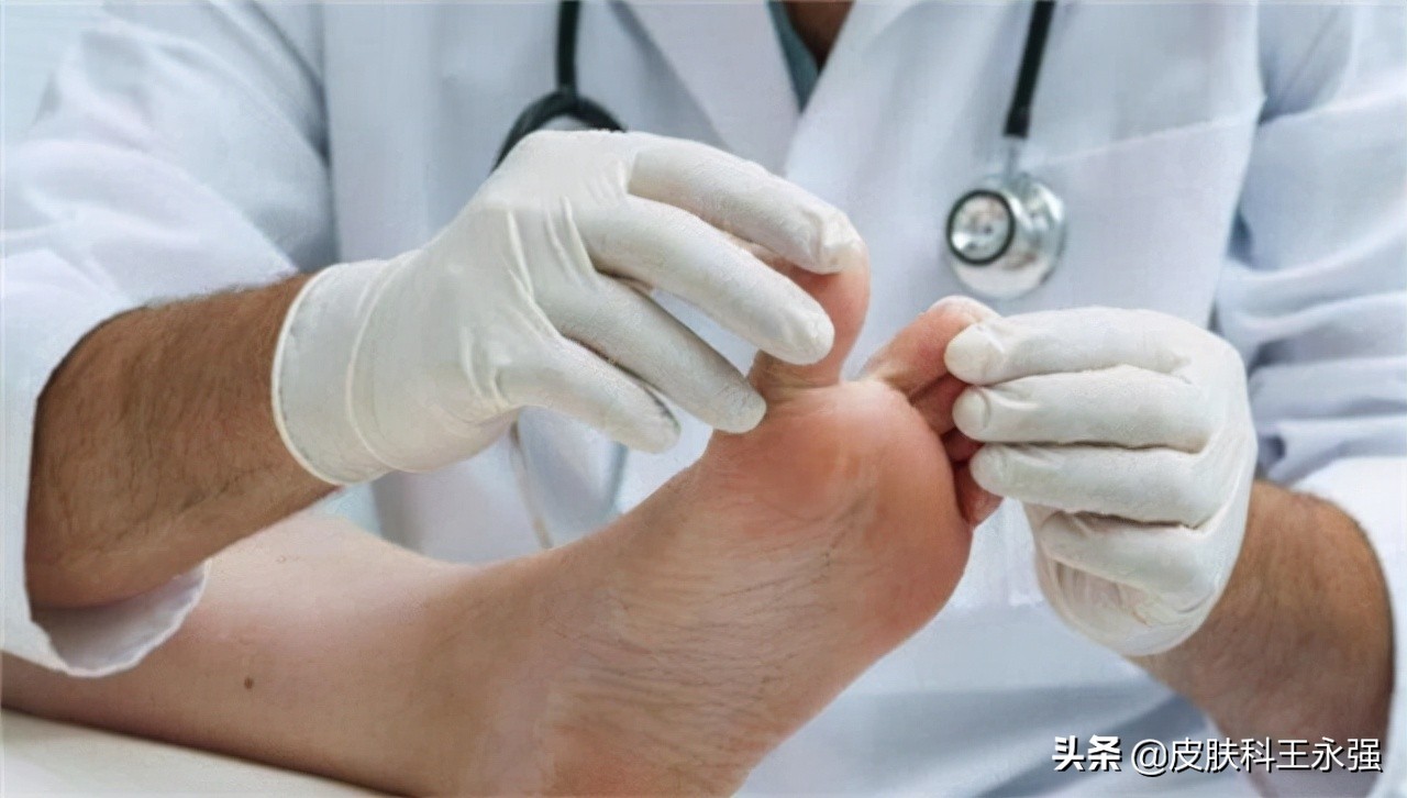 汗疱疹瘙痒严重怎么办,汗疱疹奇痒无比如何缓解