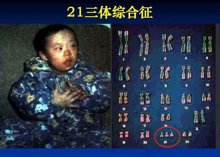 七种孕妇容易出唐氏儿,40岁孕妇唐氏筛查出高风险