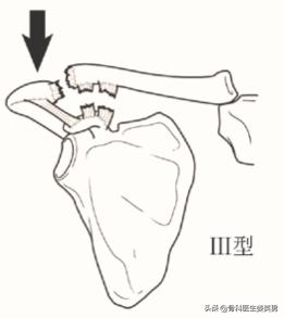 武磊左肩骨错位韧带撕裂,武磊首次回应左肩伤势