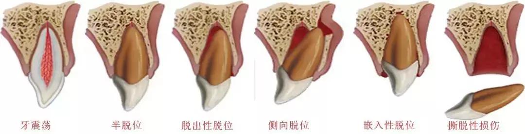 牙齿咬硬物受伤,牙齿受伤吃什么恢复