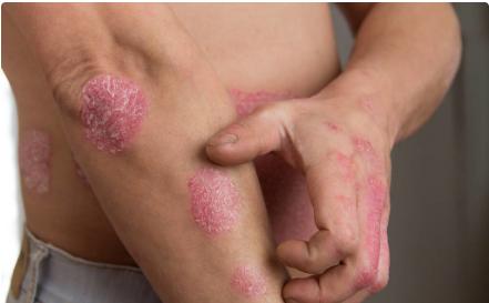 银屑病一辈子不复发的也有可能吗,银屑病一辈子没复发是真的吗