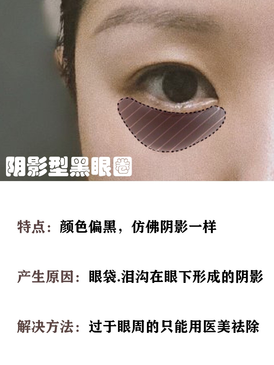 这7个方法迅速缓解你的黑眼圈,如何才是解决黑眼圈的最好方法