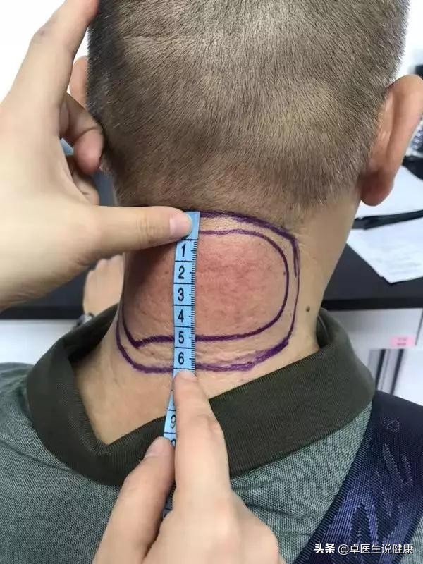 中医颊针案例分享:颈部包块20年,通过中医颊针疗法解决问题