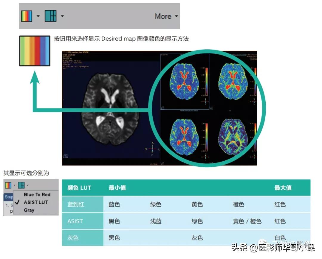飞利浦磁共振波谱成像扫描技术,飞利浦磁共振纵隔扫描技术