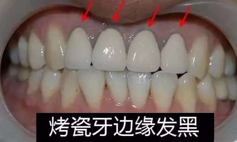 做了烤瓷牙之后牙根部变黑怎么办,做了烤瓷牙牙根黑的怎么办