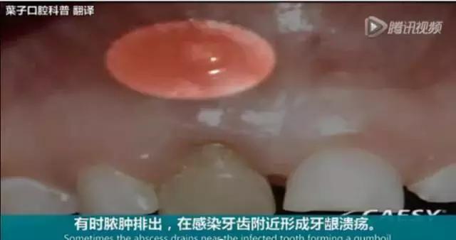 牙龈反复鼓包流脓是牙齿坏了吗,一上火牙龈就鼓包