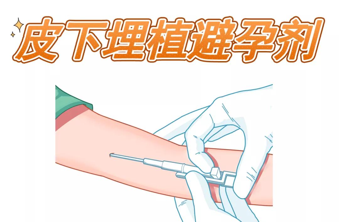 皮下埋置避孕是新技术吗,最新避孕方法皮下埋植