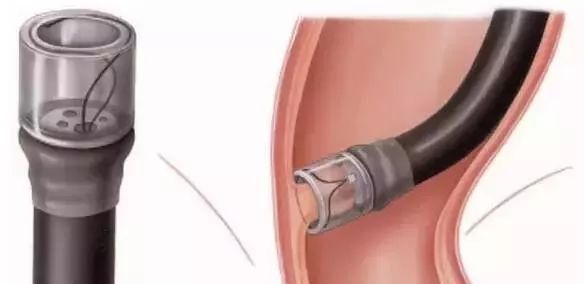 emr和esd消化内镜哪个好,内镜下esd和emr治疗的区别