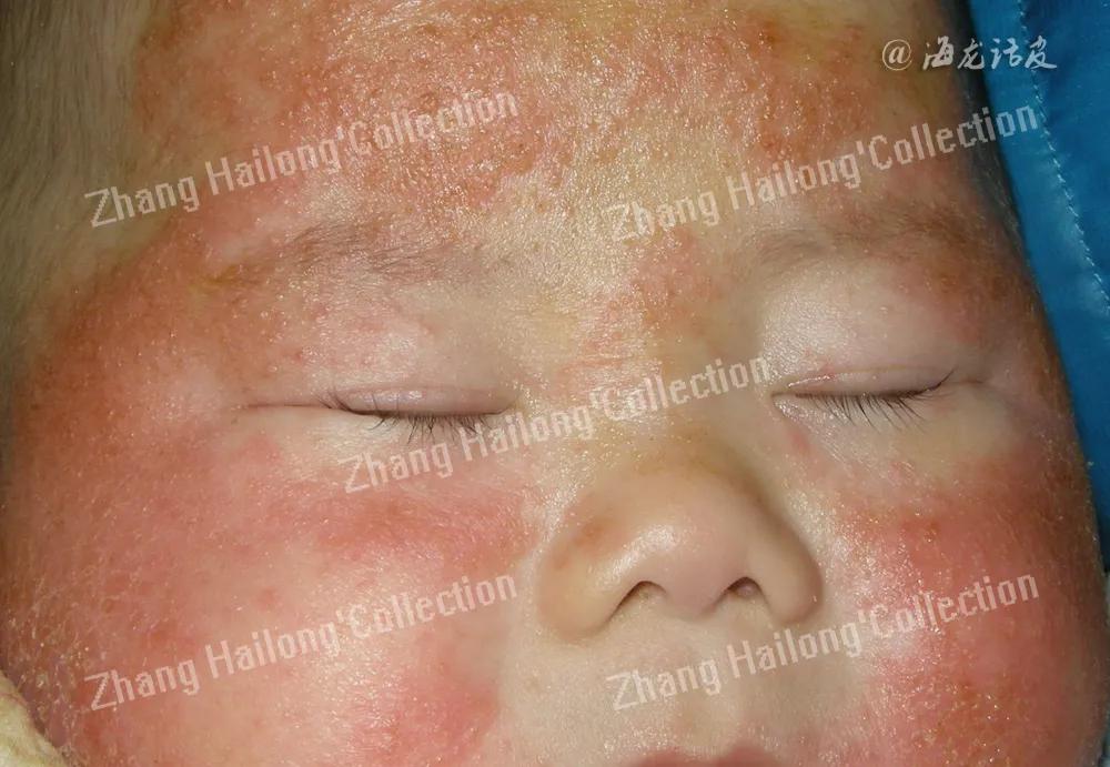 儿童麻疹的防治措施,儿童荨麻疹断根的土方法