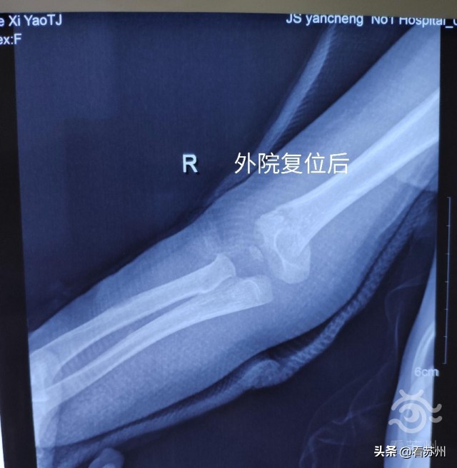 小女孩骨折神奇复位视频,骨折女孩正骨复位