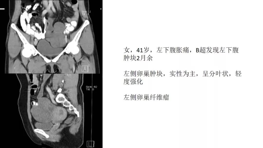 卵巢原发肿瘤的分析思路