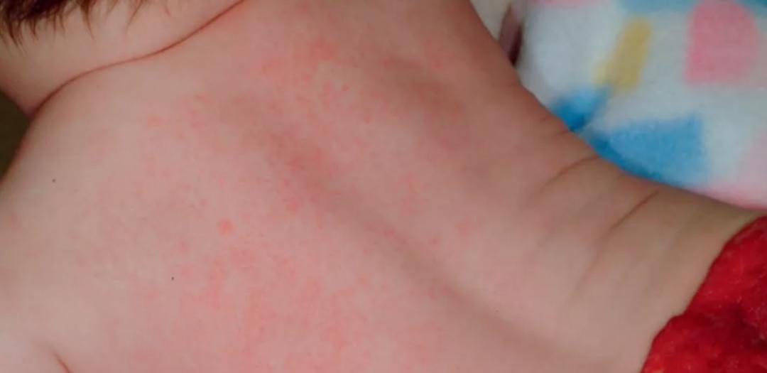 热痱子与汗疱疹的区别,汗疱疹和痱子的区别