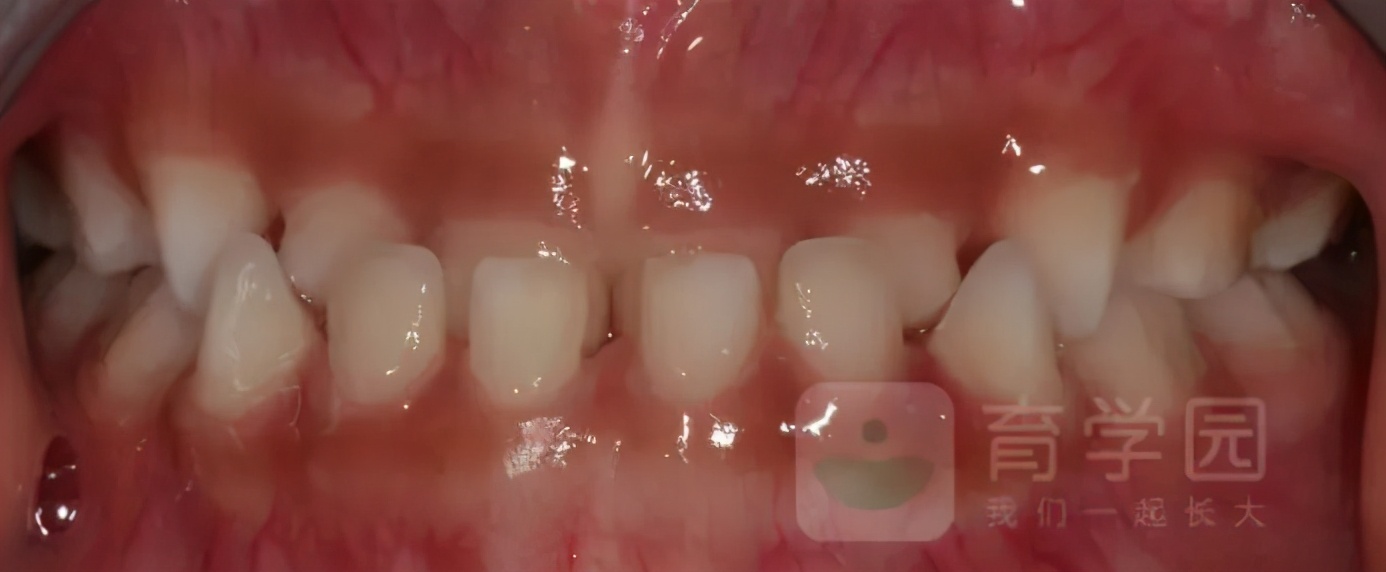 长期使用奶嘴宝宝会变丑,有什么办法给宝宝戒奶嘴