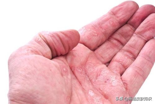 皮炎会传染别人吗,下体皮炎传染吗