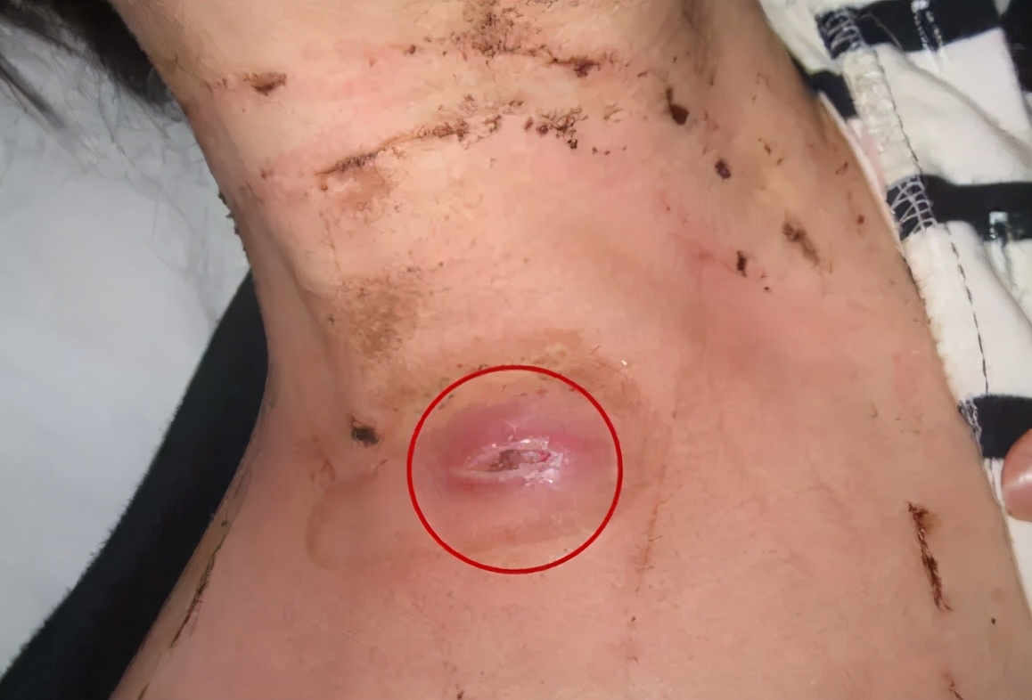 淋巴结核怎么治疗能彻底根除掉,淋巴结结核复发能不能彻底治愈