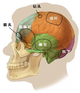 开颅手术经过哪些结构,开颅手术是几类手术