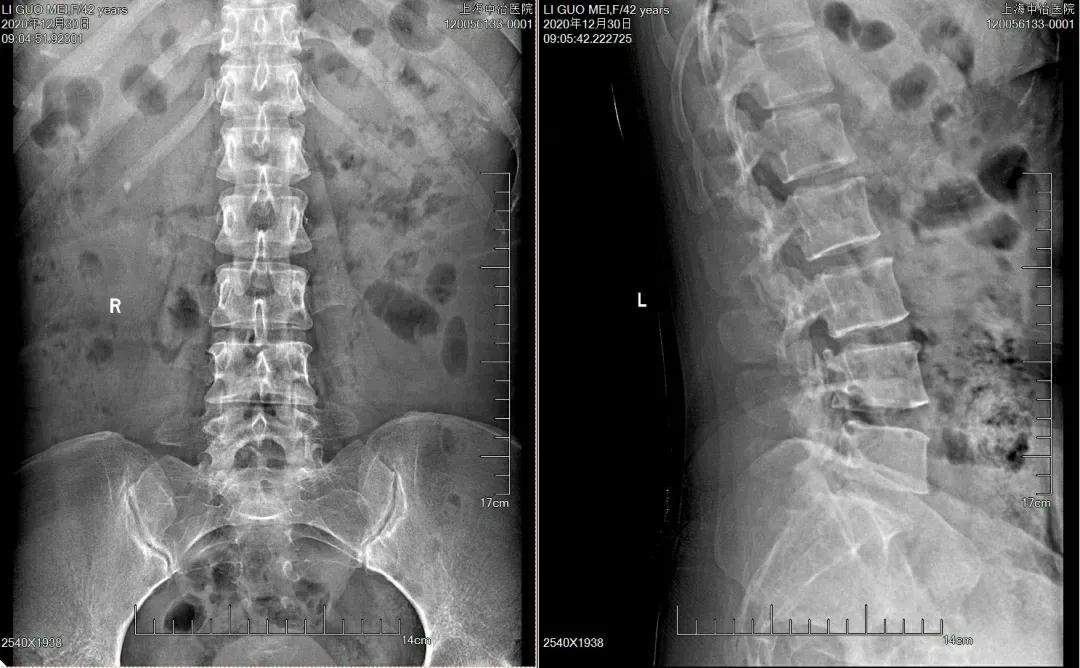 腰疼腿不疼会是椎间盘突出吗,椎间盘突出引起的腰痛怎么治
