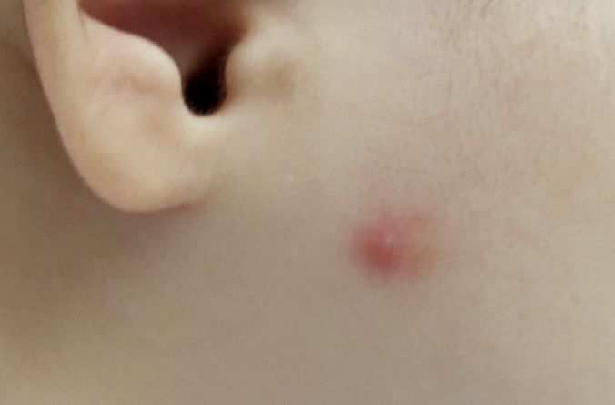 宝宝出去防蚊子叮咬的最佳方法,宝宝一直被蚊子咬怎么驱蚊