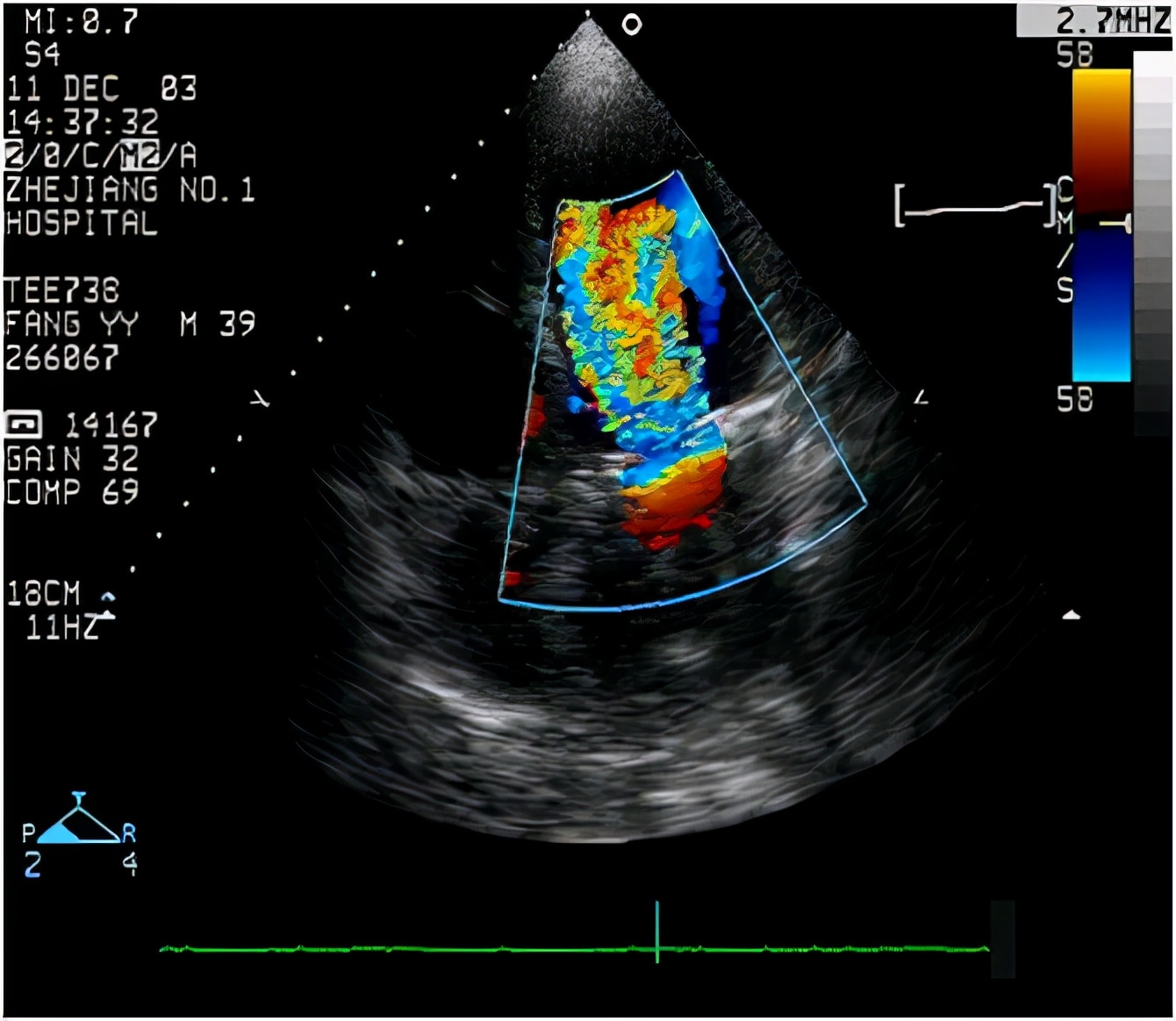 50岁女医生献血时发现异常，检查发现心脏破了个“洞”，女性多见