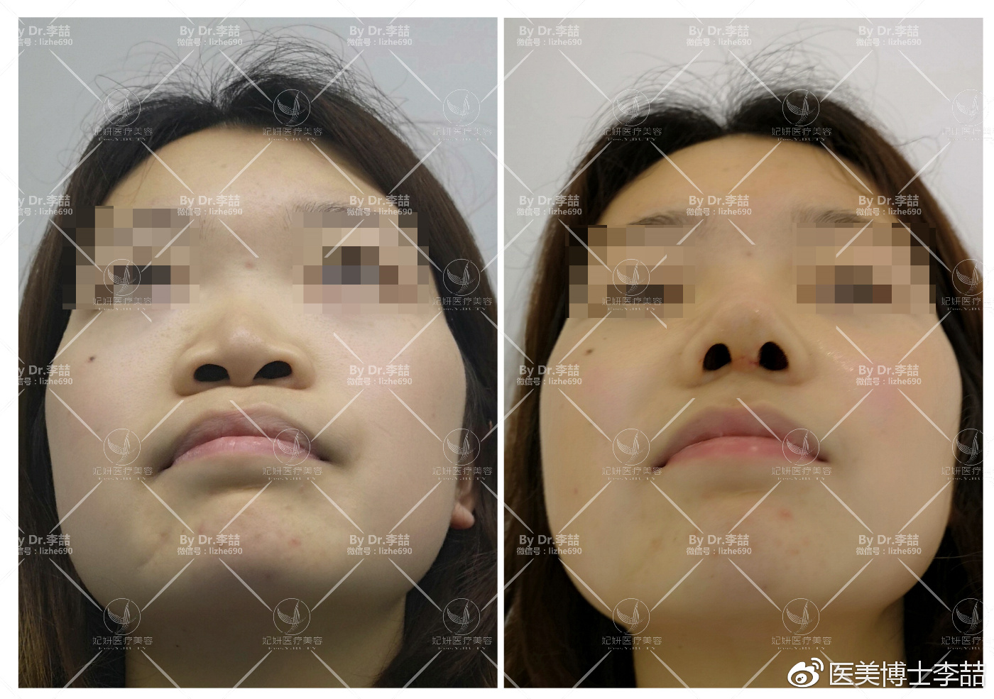 先天性鼻缺损和畸形的修复,先天性鼻中隔缺损