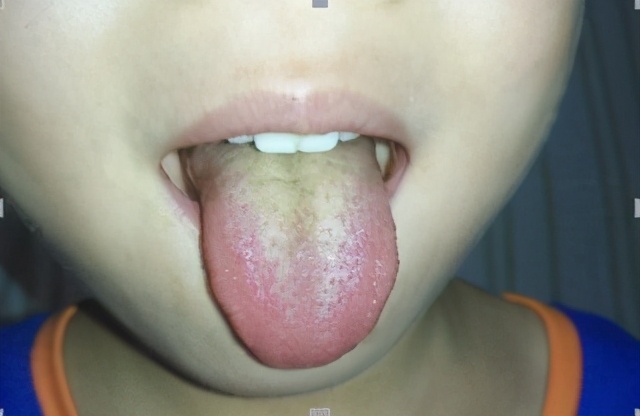 一招教你看舌苔图片,一张图看懂孩子学习