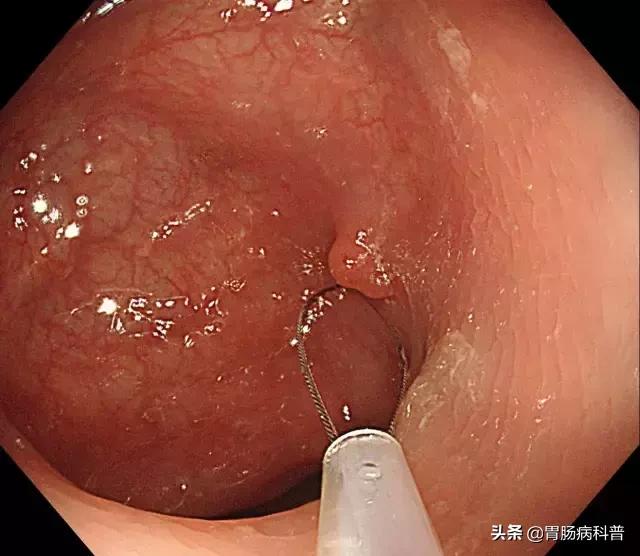 长了胃息肉怎么办,长了胃息肉怎么办才好